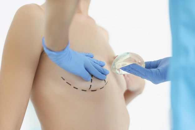 breast-reconstruction